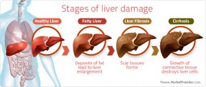 Liver-Damage-Stages-2